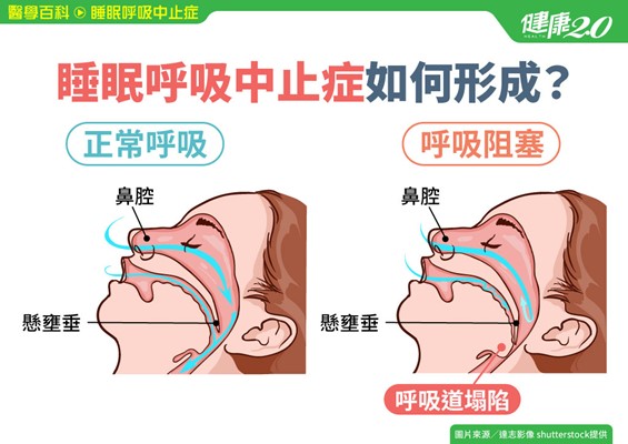 台灣Apple Watch 開放睡眠呼吸中止症偵測功能 - 電腦王阿達